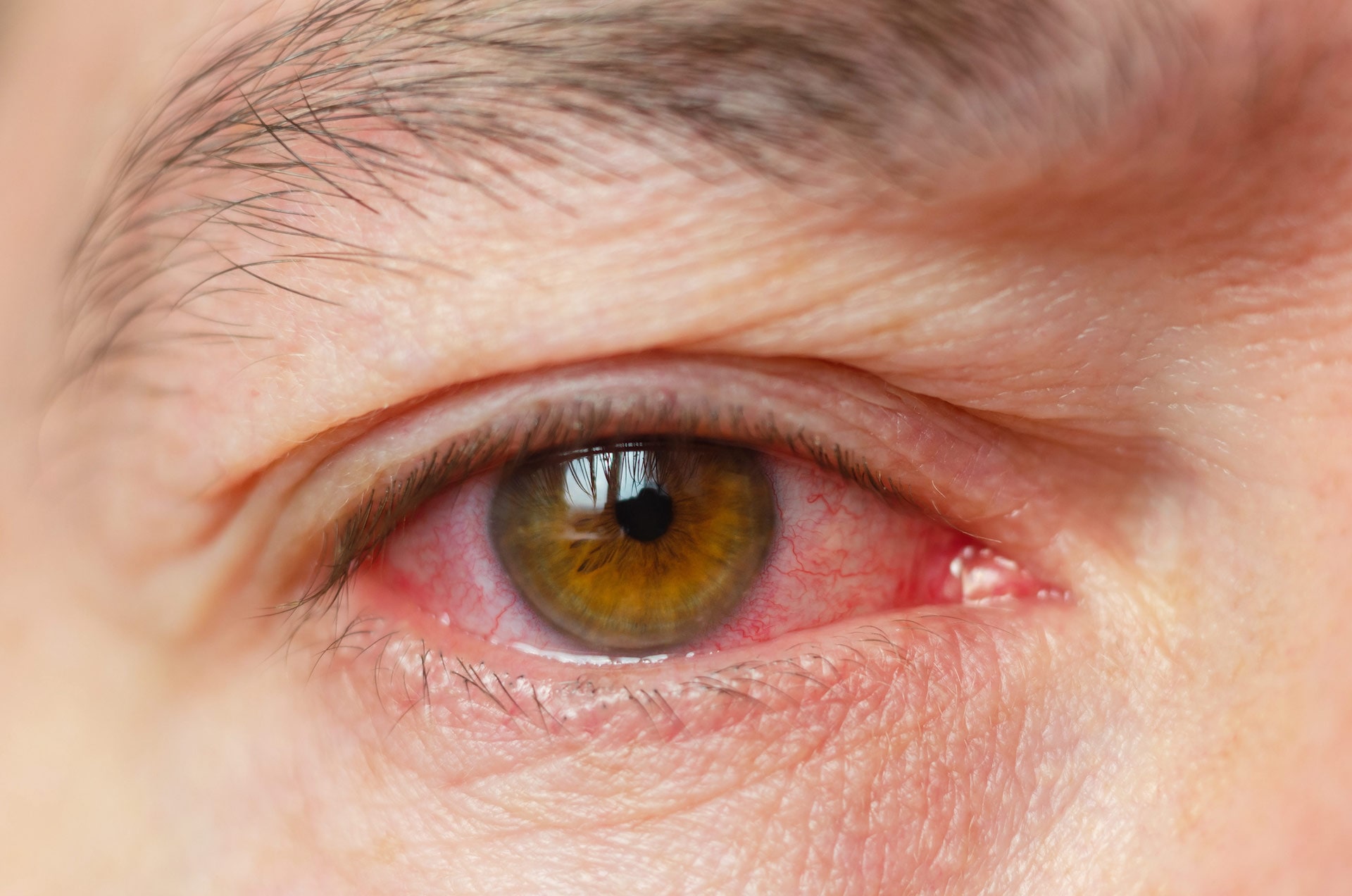 close up image of a bloodshot eye