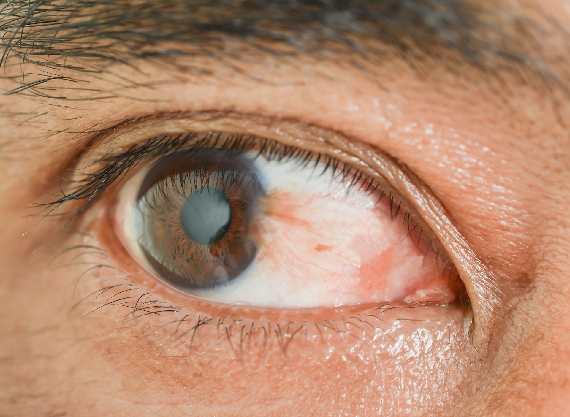close up image of a bloodshot eye