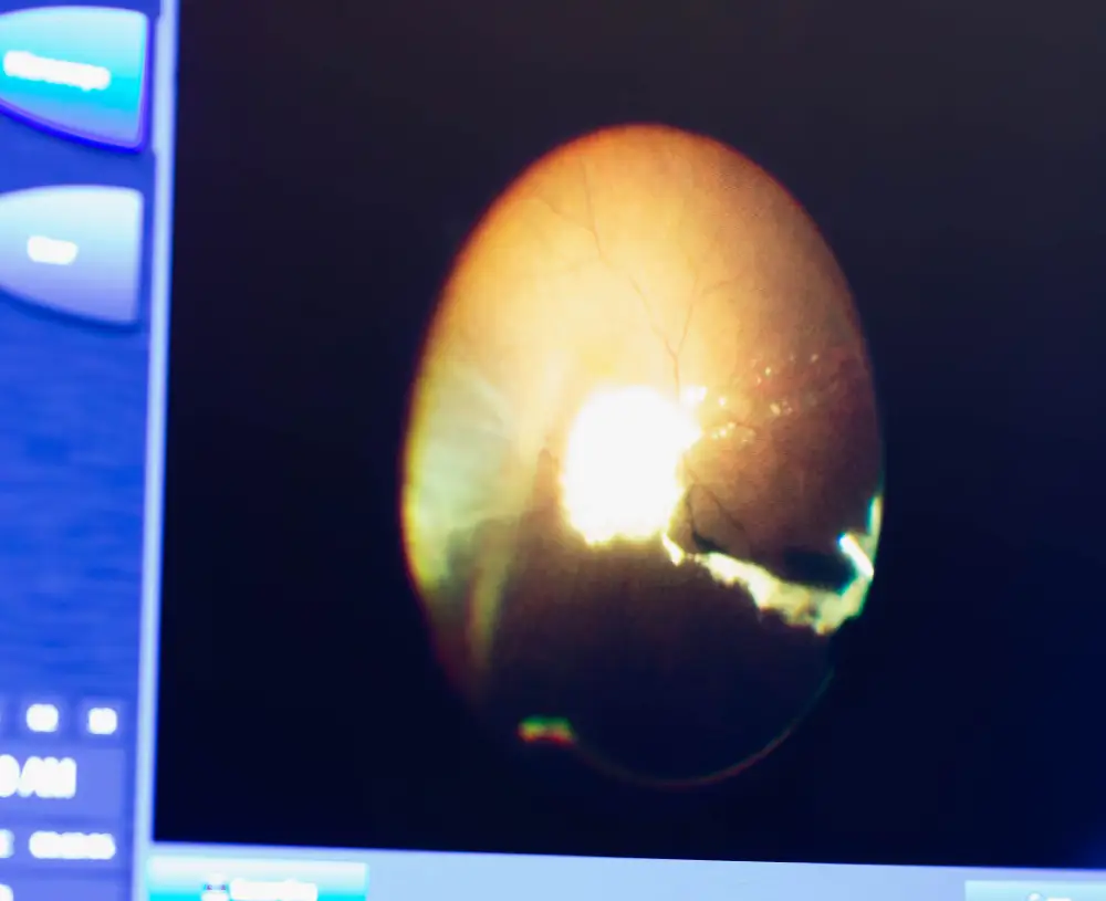 What is Retinal vein occlusion